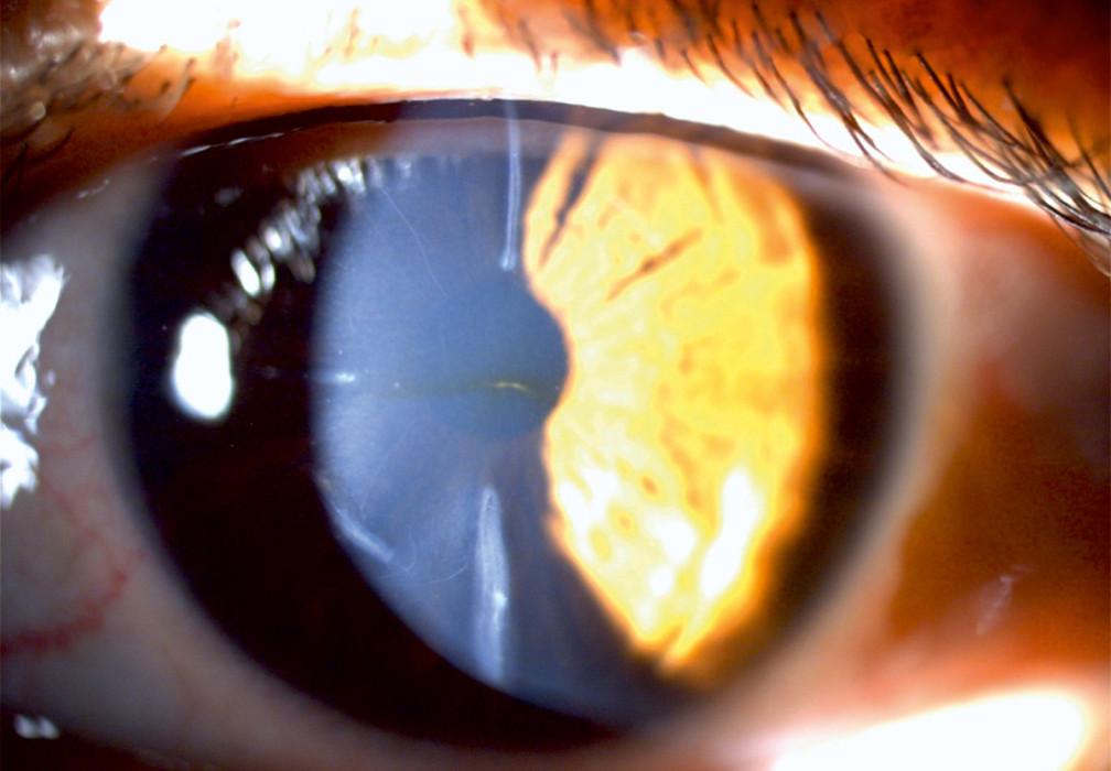 Augenoptisches und optometrisches Zentrum Optik Mattern - Ihr Optiker in Wiesloch und Sandhausen. Sklerallinsen eigenen sich bei unregelmäßiger Hornhaut und trockenen Augen.