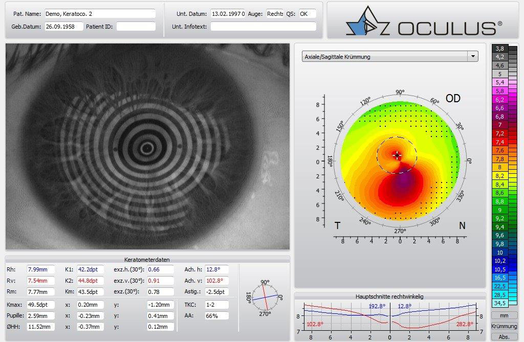 Augenoptisches und optometrisches Zentrum Optik Mattern - Ihr Optiker in Wiesloch und Sandhausen. Bei Optik Mattern wird die Augenform mit modernsten computergesteuerten Messgeräten ermittelt.